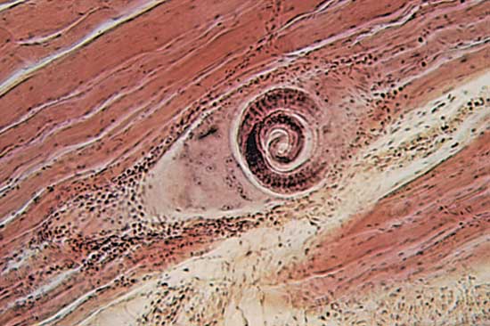 Еще раз о трихинеллезе